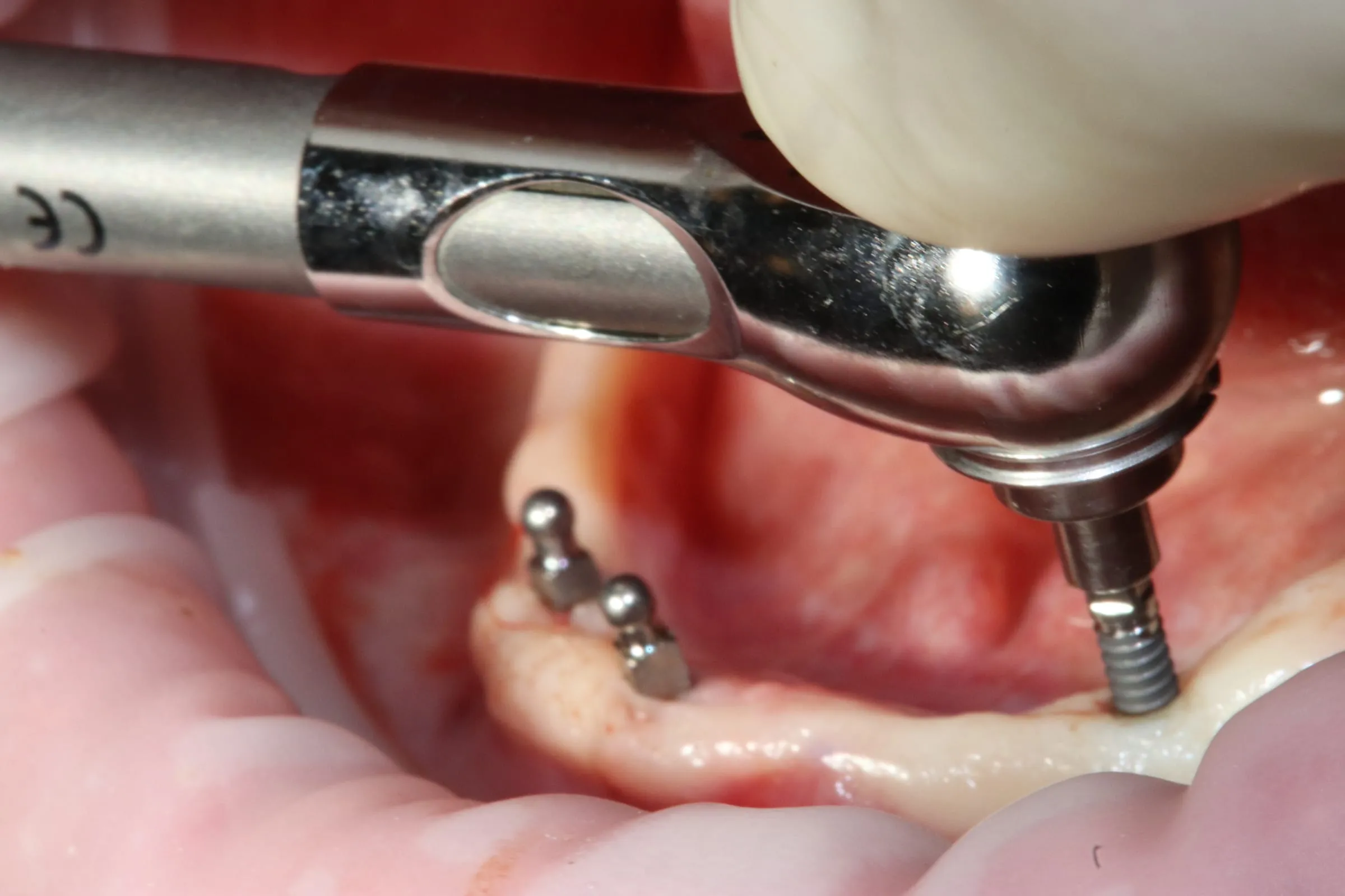 Inserarea unui implant dentar cu instrumentar calibrat la Cocard