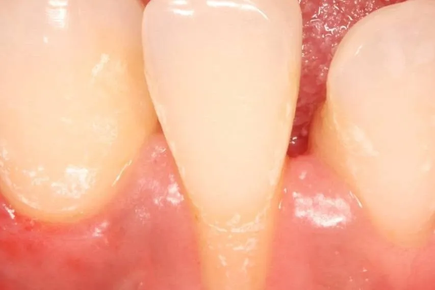 Detaliu clinic cu retracție gingivală înainte de tratament