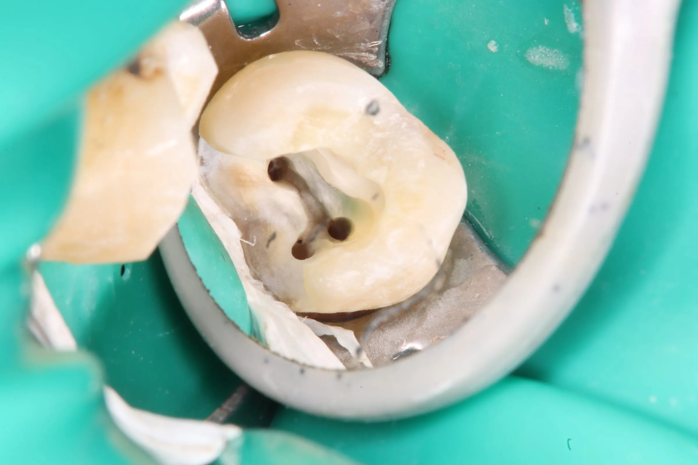 Tratament de canal realizat sub izolare cu digă dentară la Cocard